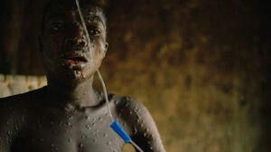 PATIENTS WITH MPOX