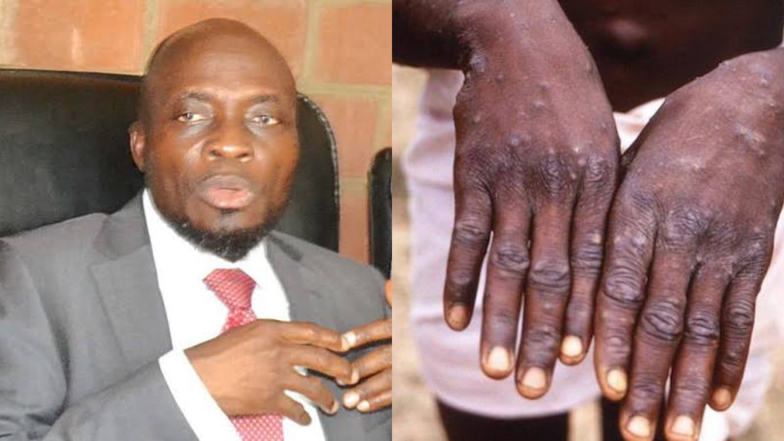 Dr Isamotu and monkeypox