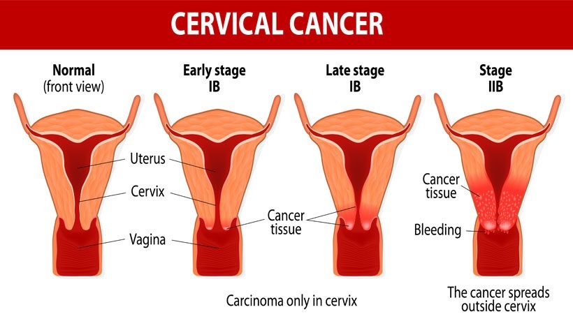 Cervical cancer chart