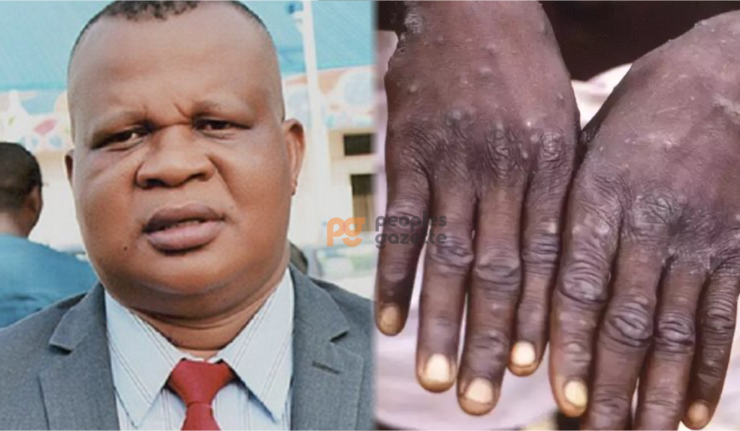 Ebonyi Health commissioner Daniel Umezuruike and Monkeypox