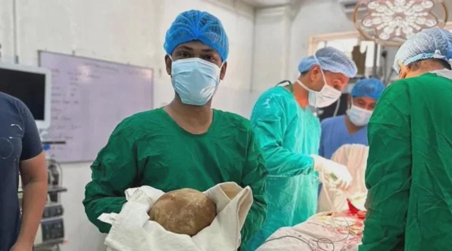 Doctors with the removed bladder stone