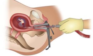 abortion