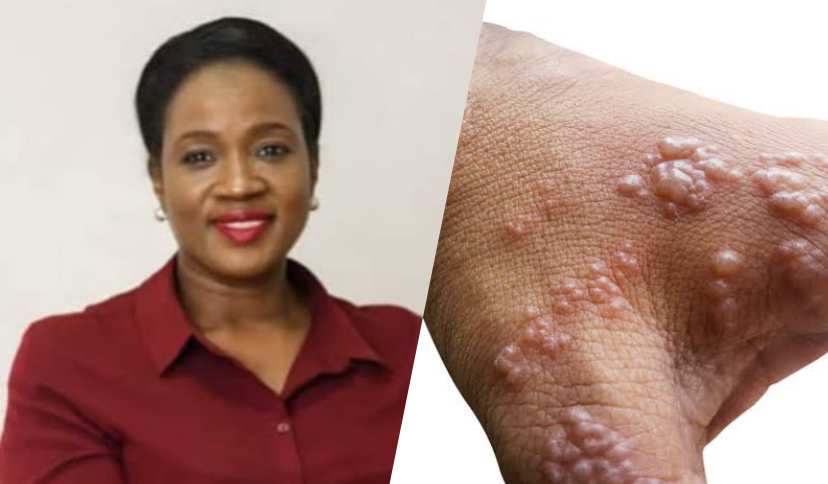 Tomi Coker and monkeypox