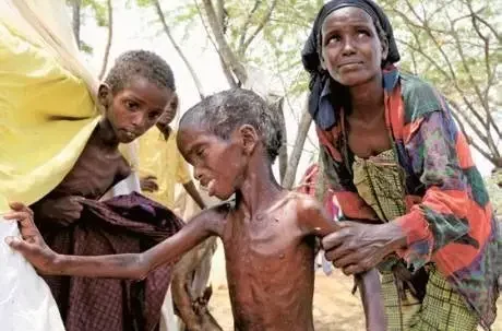 Malnourished Somali kids