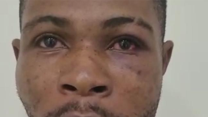 Okachi’s bruised eye