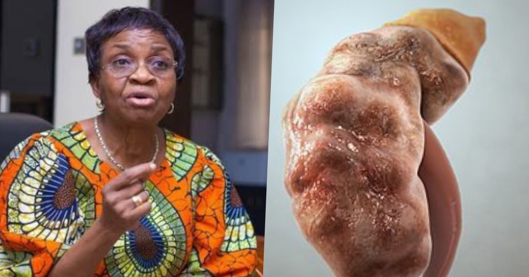 NAFDAC DG, Mojisola Adeyeye and a damaged kidney used to illustrate this story