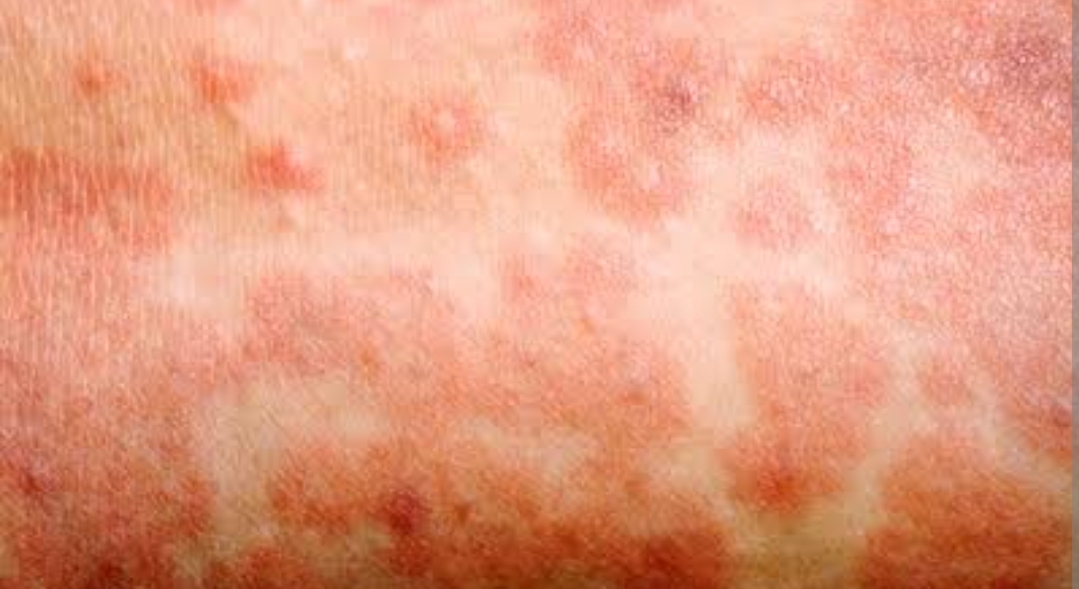 Measles infected skin