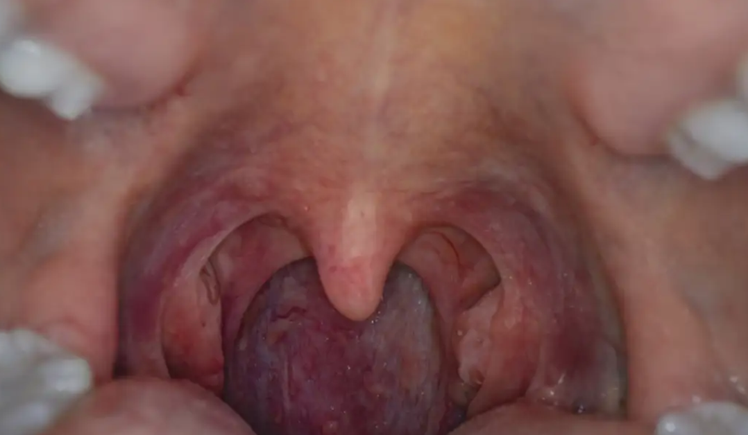 Throat cancer