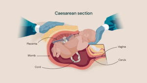 Caesarean section