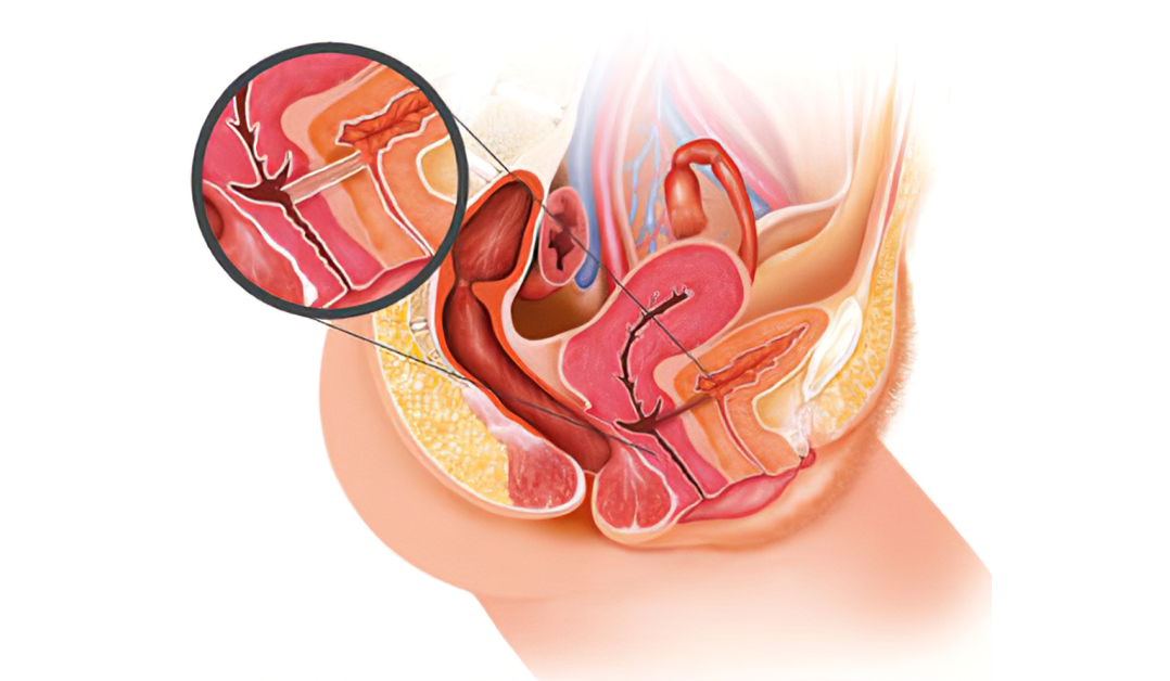Vesicovaginal fistula illustration