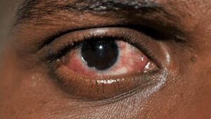 Conjunctivitis