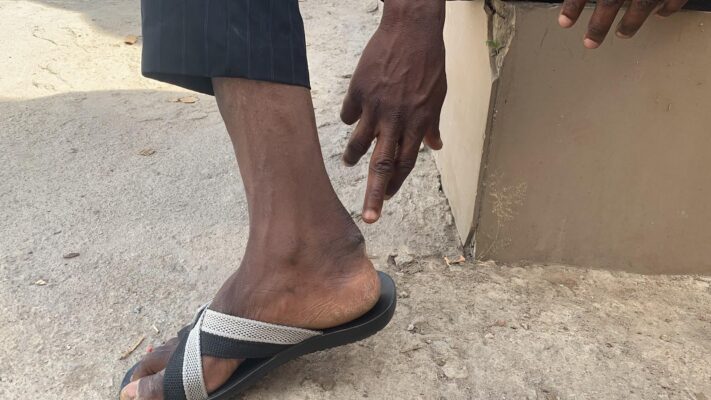Mr Abubakar displays wounds sustained from months of torture.