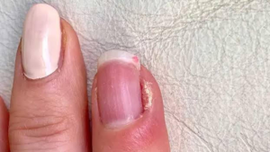 fingernail