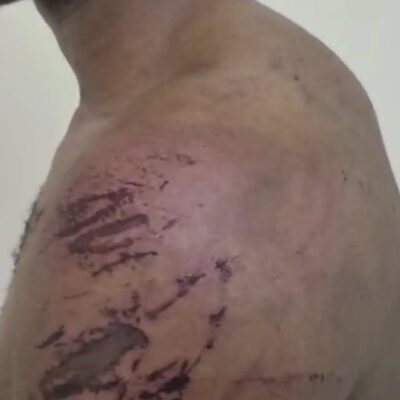 Okachi’s bruised body