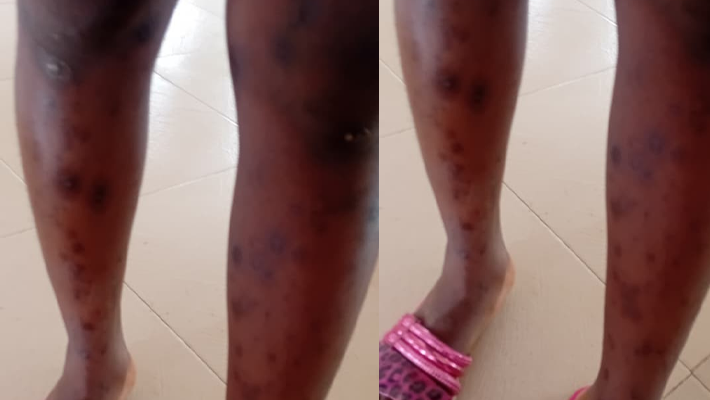 Mrs Adebowale shows the legs of her daughter covered in marks from her time in captivity.