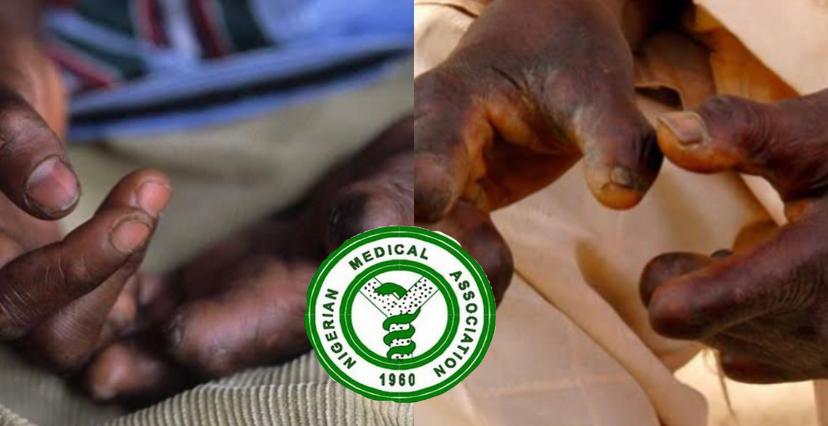 Nigerian Medical Association (NMA) and Leprosy