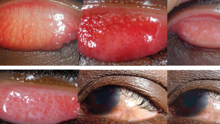 Trachoma