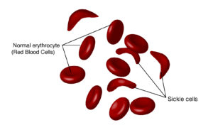 sickle cell