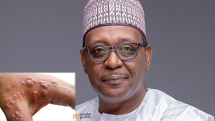Mpox and Muhammad Ali Pate