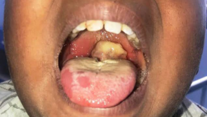 DIPHTHERIA PATIENTS