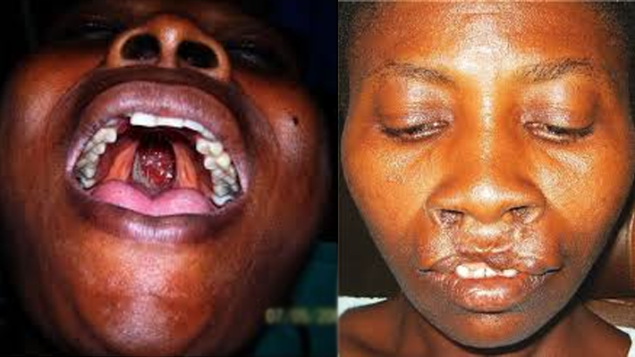 Cleft patient